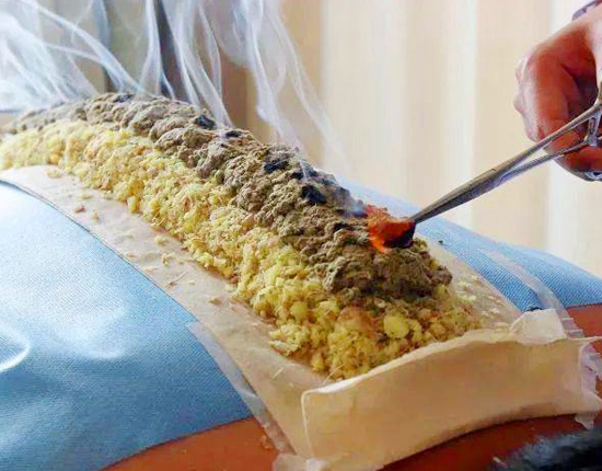 扶阳督脉灸