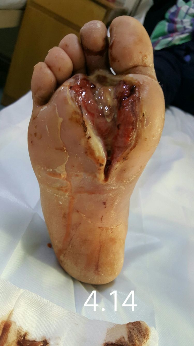 糖尿病足，烂穿脚背【访谈记录】